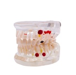 Caries Demonstration Typodont for Dental Training and Education