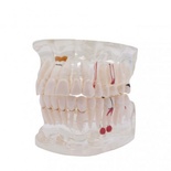 Transparent Typodont with Implant for Dental Training and Demonstration