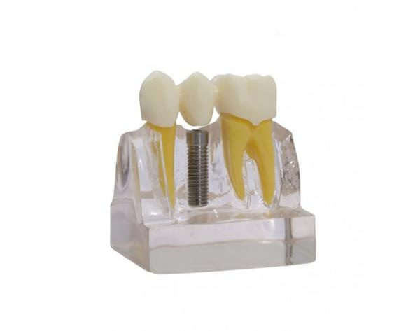 Implant-Bridge Demonstration Model for Dental Training and Presentation