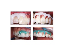 OpalDam: Light Curing Gingival Protector