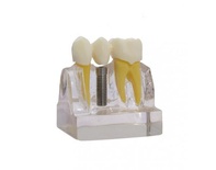 Implant-Bridge Demonstration Model for Dental Training and Presentation
