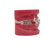 Metallic and Sapphire Brackets Dental Typodont Model