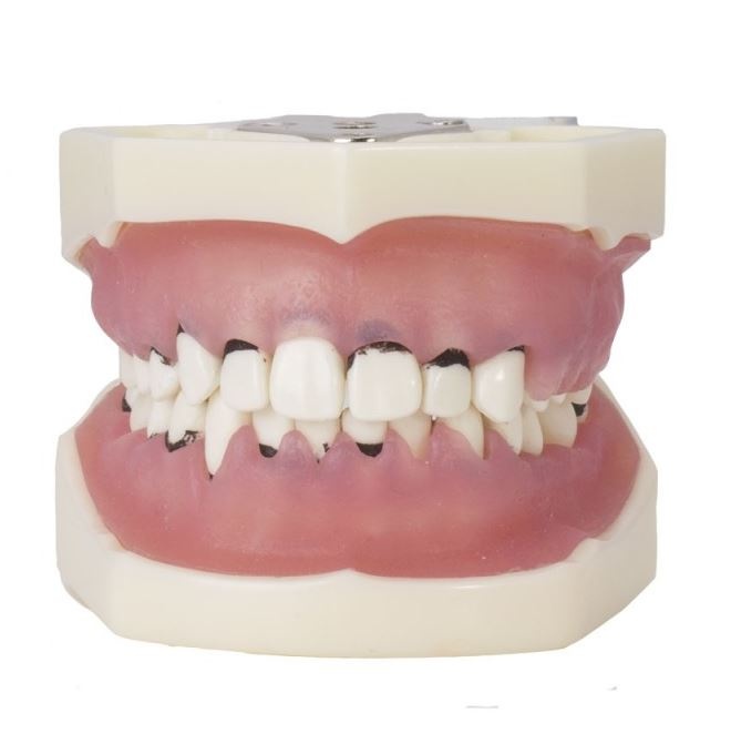 Articulated Periodontics Dental Model for Professional Use