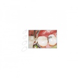 LM Contact Formers for Precise Dental Restorations