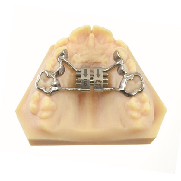 CAD-CAM Tooth Terminal Quick Expander Screw