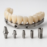 Implant Full E-Max crown