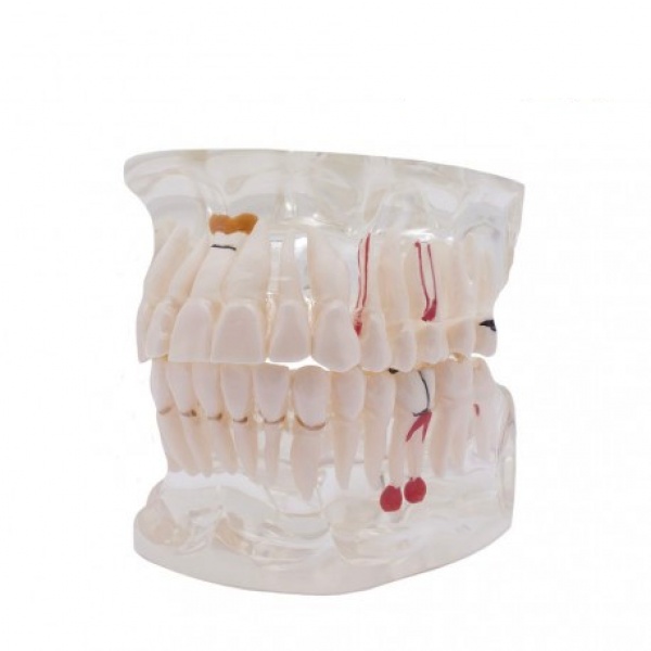 Transparent Typodont with Implant for Dental Training and Demonstration