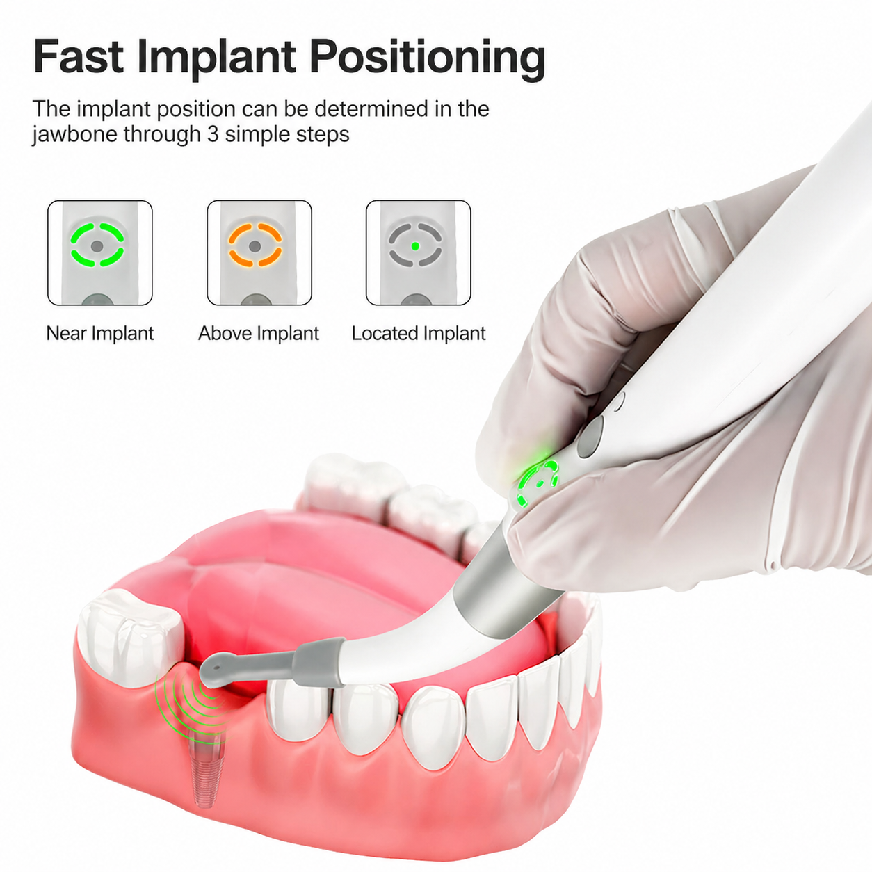 Dental implant locator