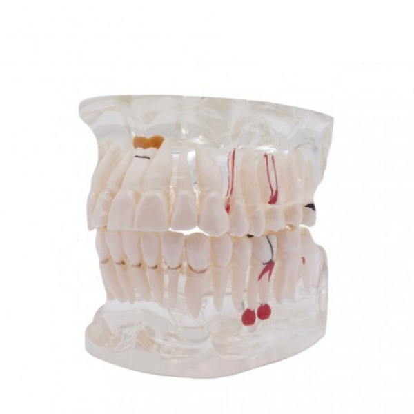 Transparent Typodont with Implant for Dental Training and Demonstration