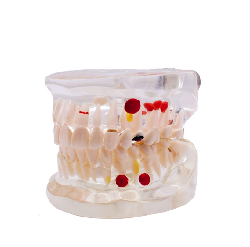 Caries Demonstration Typodont for Dental Training and Education