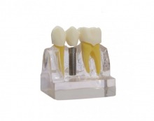 Implant-Bridge demonstration model