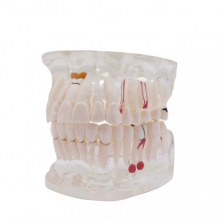 Transparent Typodont with Implant