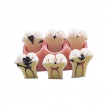 Removable Caries Model